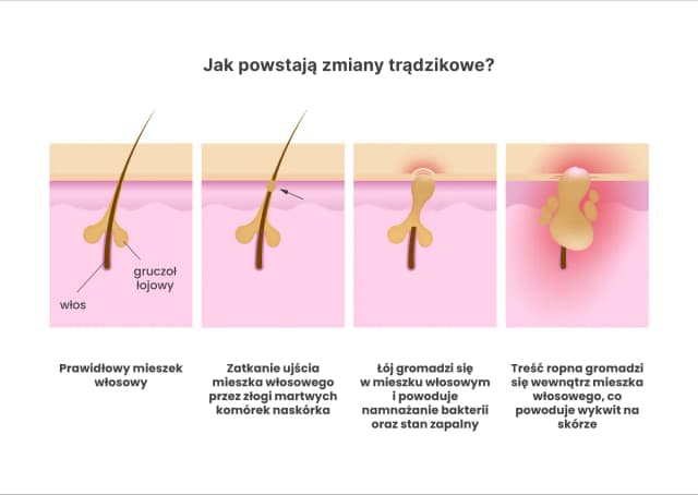 Jak powstaje pryszcz? Poznaj przyczyny i skutki trądziku Jak powstaje pryszcz? Poznaj przyczyny i skutki trądziku