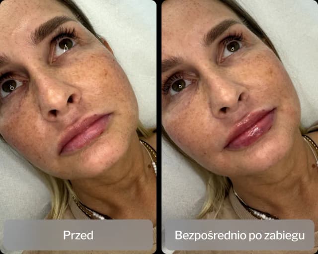 Co robi kwas hialuronowy i jak może odmłodzić Twoją skórę? Co robi kwas hialuronowy i jak może odmłodzić Twoją skórę?